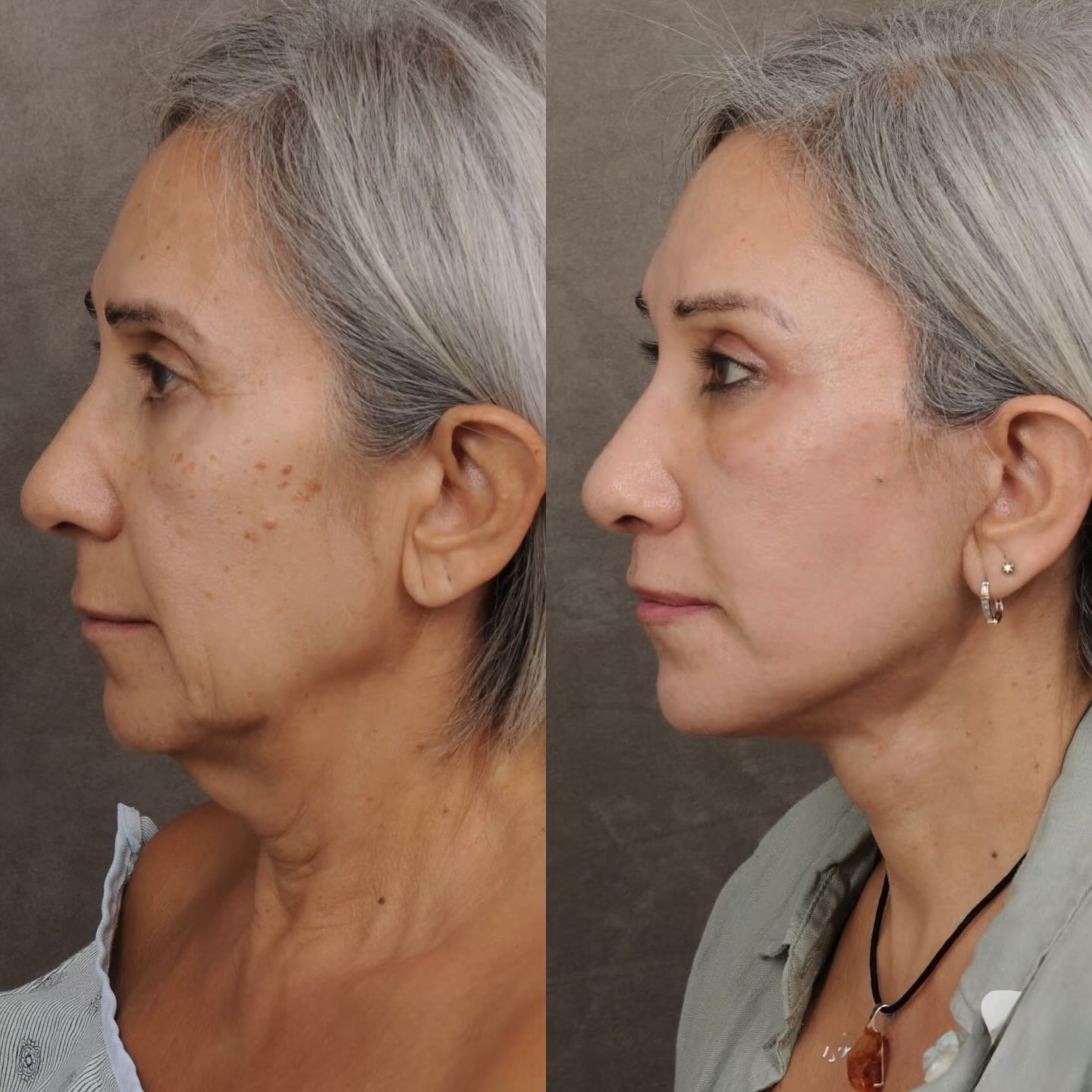Before and after comparison 01
